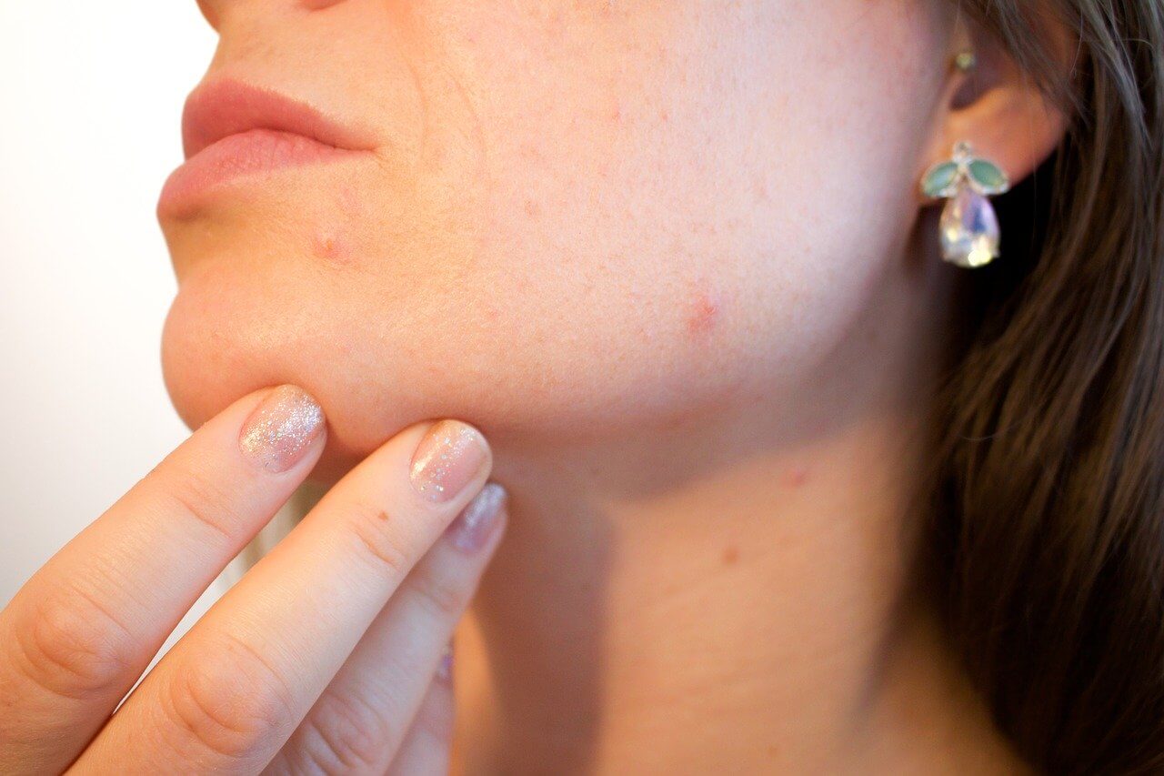 acne behandeling hilversum