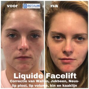 liquid-behandeling-facelift