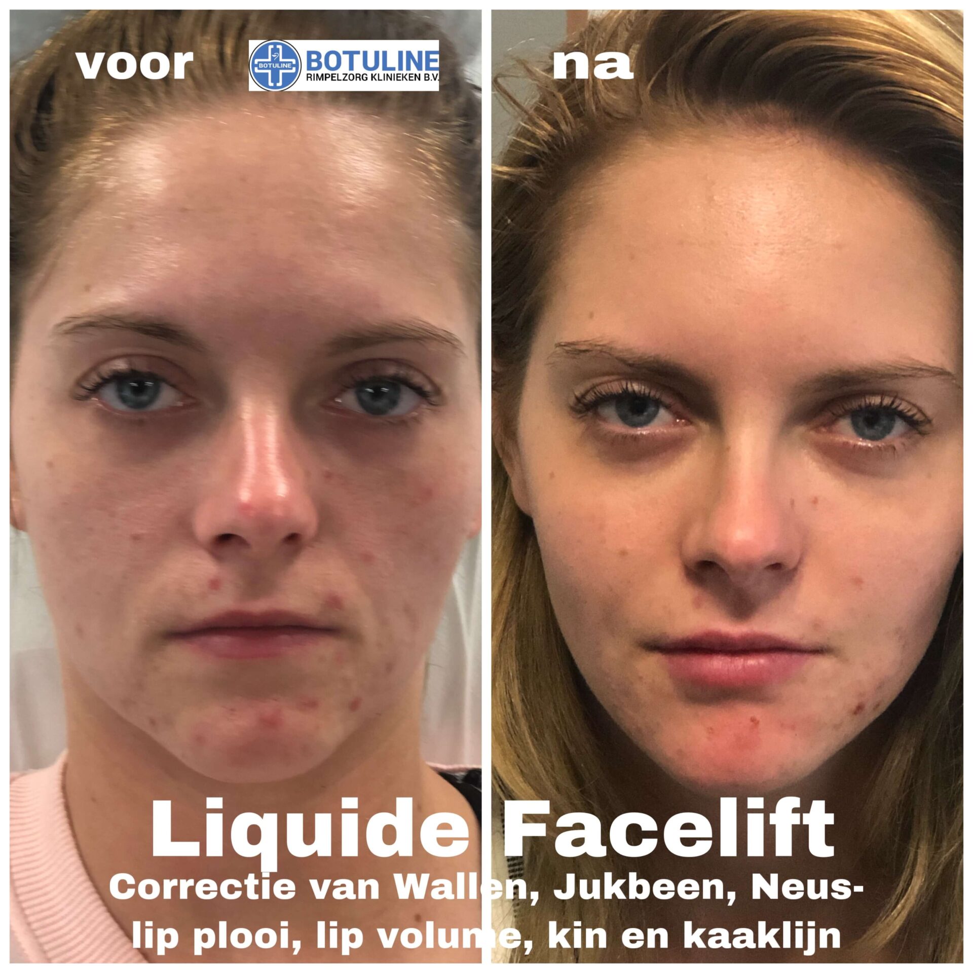 liquid-behandeling-facelift